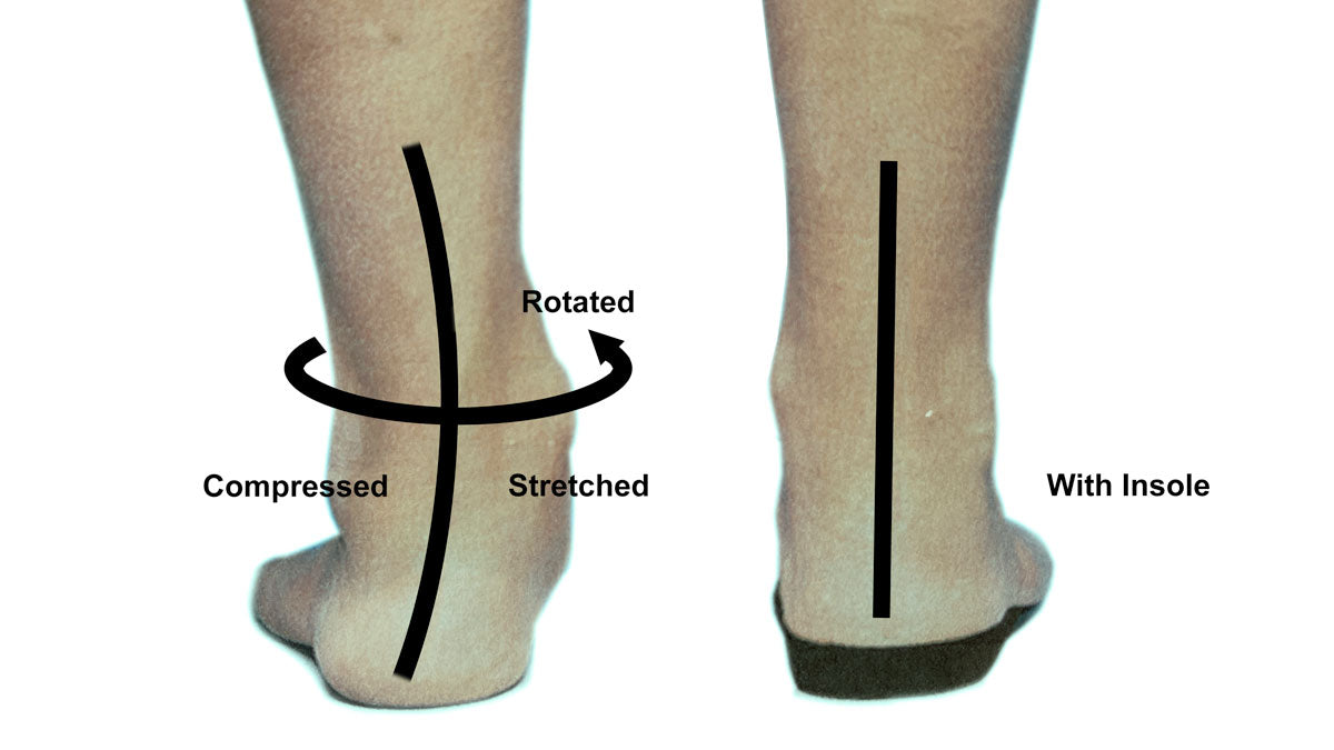 Insoles and achilles pain